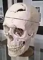 Gage's skull on display at Harvard University
