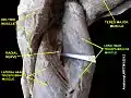Long head triceps brachii muscle (shown in green text)
