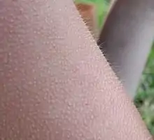 An arm with chill bumps, goose bumps, or goose pimples.