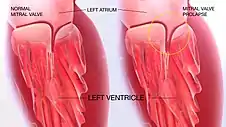 3D Medical Animation still shot of Mitral Valve Prolapse