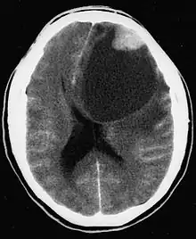 An image of a brain with pleomorphic xanthoastrocytoma