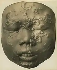 Secondary breakout in a 12-year-old  Javanese child (wax model)