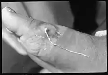 A white worm emerging from a wound on a person's foot