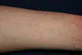 Scabies of the arm