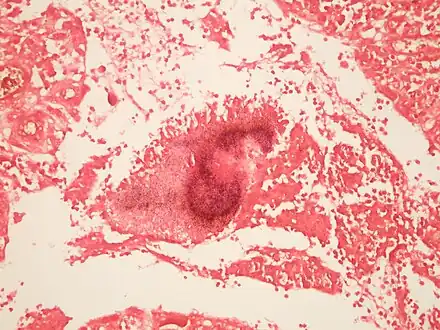 Micrograph of actinomycosis, Gram stain