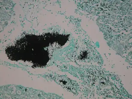 Micrograph of actinomycosis, GMS stain