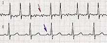 Electrocardiographic image depicting Atrial_fibrillation