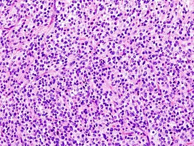 Histopathological image of anaplastic oligodendroglioma in cerebrum. Hematoxylin & eosin stain.