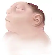 Illustration from the Centers for Disease Control and Prevention of Anencephaly.