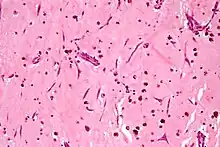 Atrial myxoma. H&E stain.