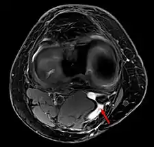 Baker's cyst on axial MRI with communicating channel between the semimembranosus muscle and the medial head of the gastrocnemius muscle.