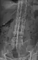 X-ray showing bamboo spine in a person with ankylosing spondylitis