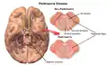 Degradation of substantia nigra associated with Parkinson's disease.