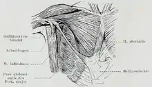 Sternalis muscle visible in an individual who also has an accessory abdominal pectoralis major, and an axillary arch of the latissimus dorsi.