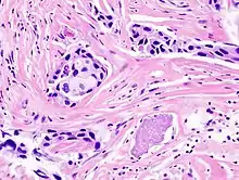 Histopathology of invasive ductal carcinoma of the breast representing a scirrhous growth.