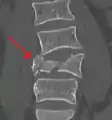 A burst fracture of L4 as seen on CT