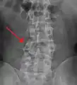 A burst fracture of L4 as seen on plane X ray