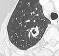 Cavitation with relatively thick wall, in this case aspergilloma).