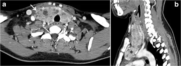 Fig. 13. A 27-year-old female patient known to have goiter. a, b Axial and sagittal enhanced CT scan images of the neck demonstrate a heterogeneously enhancing, enlarged thyroid gland with scattered calcifications (white arrow), cystic changes, and substantial retro-sternal extension (black asterisks). No lymphadenopathy or substantial airway narrowing.