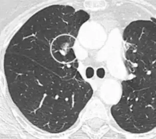 Part solid nodule.