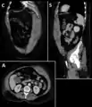 Multiplanar CT scan of a spontaneous rectus sheath hematoma because of warfarin treatment.