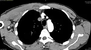 CT with IV contrast showing enlargement and heterogeneous hypodensity in the right pectoralis major muscle.  A focal abscess collection with gas within it is present medially.  There are enlarged axillary lymph nodes and some extension into the right hemithorax.  Note the soft tissue and phlegmon surrounding the right internal mammary artery and vein.  The patient was HIV+ and the pyomyositis is believed to be due to direct inoculation of the muscle related to parenteral drug abuse. The patient admitted to being a "pocket shooter"