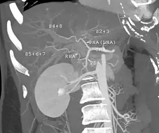 MDCT image. Arterial anatomy contraindicated for liver donation