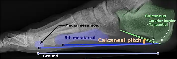 Weight-bearing lateral X-ray showing the measurement of calcaneal pitch, which is an angle of the calcaneus and the inferior aspect of the foot, with different sources giving different reference points. A calcaneal pitch of less than 17° or 18° indicates flat feet.