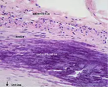 Microphotography of arterial wall with calcified (violet colour) atherosclerotic plaque (H&E stain)