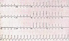 RBBB with associated tachycardia