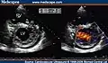 Two-dimensional parasternal and color Doppler images at the level of both ventricles that show the noncompacted:compacted wall ratio and how the color enters the intertrabecular recesses