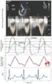 Wiggers diagram with mechanical (echo), electrical (ECG), and aortic pressure (catheter) waveforms, together with an in-ear dynamic pressure waveform measured using a novel infrasonic hemodynography technology, for a patient with severe aortic stenosis. Modified from