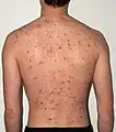 The back of a 30-year-old male after five days of the rash