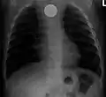 A coin seen on AP CXR in the esophagus