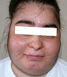 Fat tissue deposits on the sides of the face causes the patient's face to have a rounded appearance.