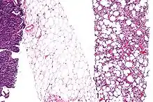 Fig. 2 Micrograph of a dedifferentiated liposarcoma tumor