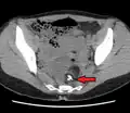 A complex cyst due to a dermoid as seen on CT. Arrow points to bone or teeth.