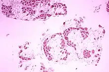 Muscular Dystrophy Histopathology