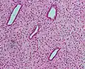 Micrograph of decidualized endometrium due to exogenous progesterone. H&E stain.