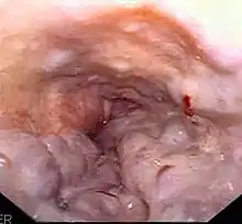 Purple longitudinal tubular structures with red spots in the esophagus at the time of endoscopy