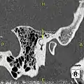 Exostosis in ear canal