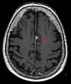 T1 (note CSF is dark) with contrast (arrow pointing to meningioma of the falx)