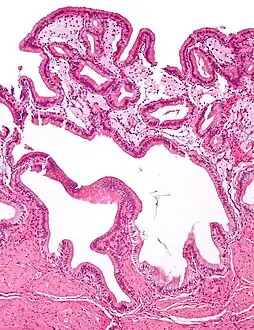 Micrograph of cholesterolosis of the gallbladder