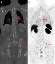 Medical images of a man's torso. Arrows indicate tumor metastases, visible as dots in the man's spine and pelvis, in both scans.