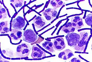 Gram-positive anthrax bacteria (purple rods) in cerebrospinal fluid: If present, a Gram-negative bacterial species would appear pink. (The other cells are white blood cells.)