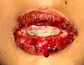 Inflammation and peeling of the lips—with sores presenting on the tongue and the mucous membranes in SJS