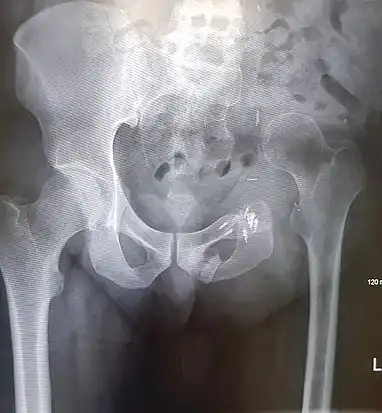 An x-ray of the same pelvis taken eighteen months after surgery highlighting the femur migration to its final resting place.