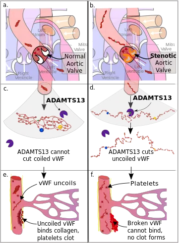 Diagram of the pathophysiology of Heyde's syndrome