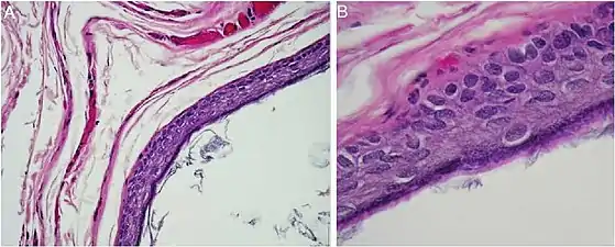 Histopathology, showing a keratinizing stratified squamous epithelium, and a lumen containing keratin flakes