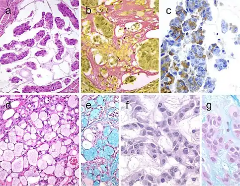 Mucinous thyroid carcinoma (a) showing abundant mucoid material mucicarmine positive (b); most tumor cells were positive for thyroglobulin (c). In this mucinous variant of follicular thyroid carcinoma (d), the follicles were distended and full of Alcian blue–positive mucinous material (e). Mucinous variant of papillary thyroid carcinoma (PTC) (f), the tumor showed ribbon, trabecular and/or follicular pattern, classic nuclear features of PTC and abundant mucoid stroma positively stained with Alcian blue (g)